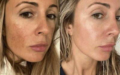 How Much Does Morpheus8 Cost in Sarasota? Skin Tightening with Fractional RF Microneedling