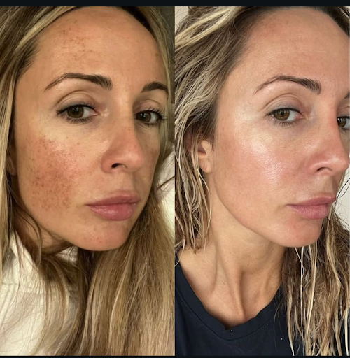 How Much Does Morpheus8 Cost in Sarasota? Skin Tightening with Fractional RF Microneedling