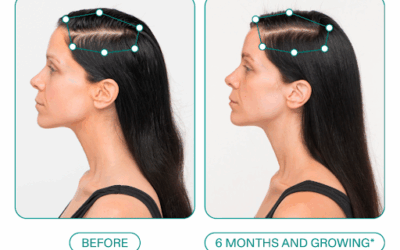 Exosome Hair Restoration Sarasota FL: For Non-Surgical Hair Regrowth at a Leading Med Spa