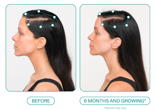 Exosome Hair Restoration Sarasota FL: For Non-Surgical Hair Regrowth at a Leading Med Spa