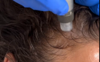 Hair Loss Treatment Sarasota (What Works Best?)