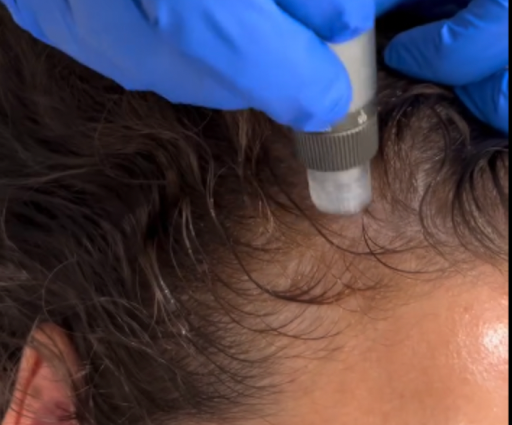 Hair Loss Treatment Sarasota (What Works Best?)