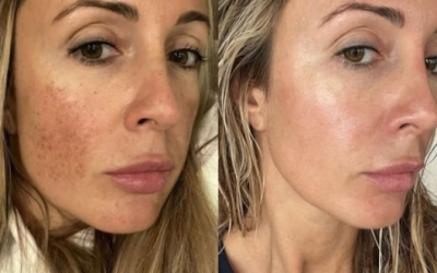 What to Expect After Morpheus8 Treatment Sarasota: Results Week by Week