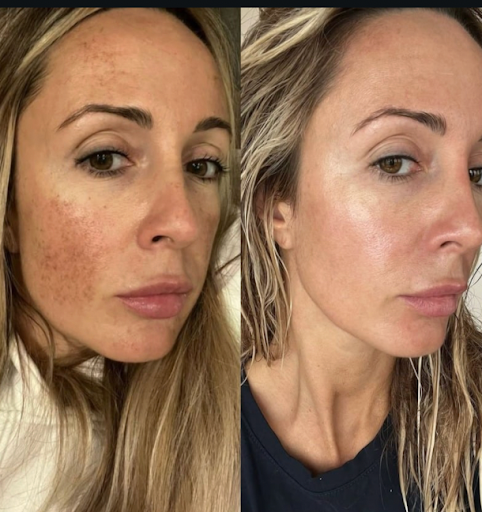 What to Expect After Morpheus8 Treatment Sarasota: Results Week by Week