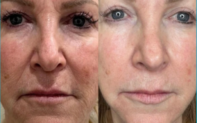 Best Anti-Aging Treatments Sarasota (That Actually Work)