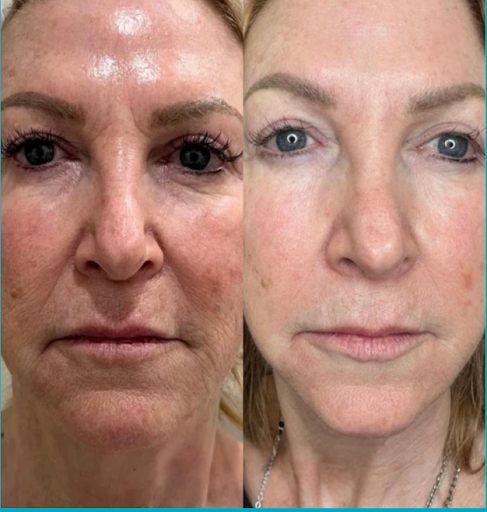 Best Anti-Aging Treatments Sarasota (That Actually Work)