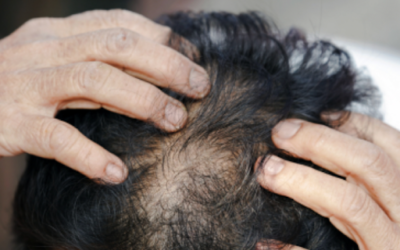 Does Exosome Therapy Really Work for Hair Loss? Hair Regrowth Benefits & Results